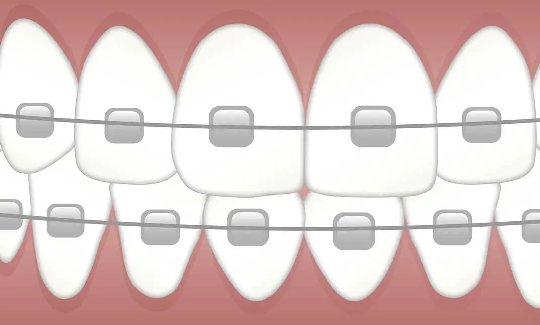 Cost Of Braces In Kenya Today | New Market Prices